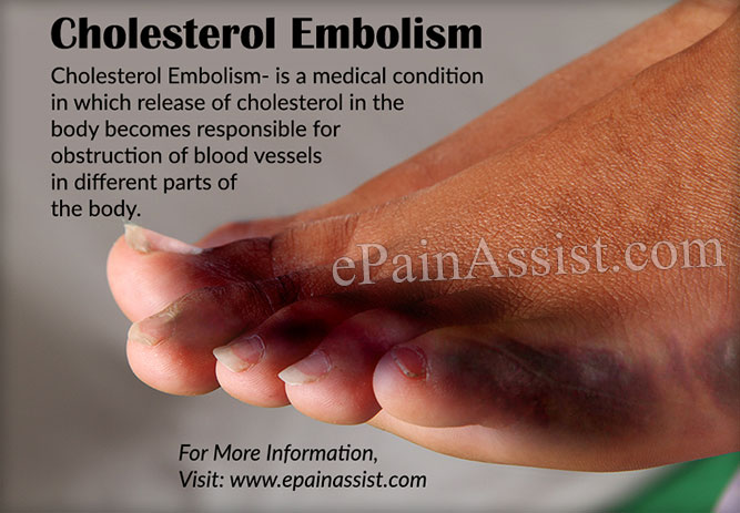 cholesterol embolism
