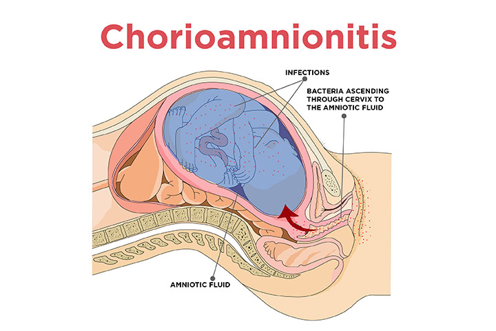 chorioamnionitis