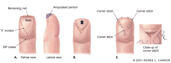 double-flap amputation