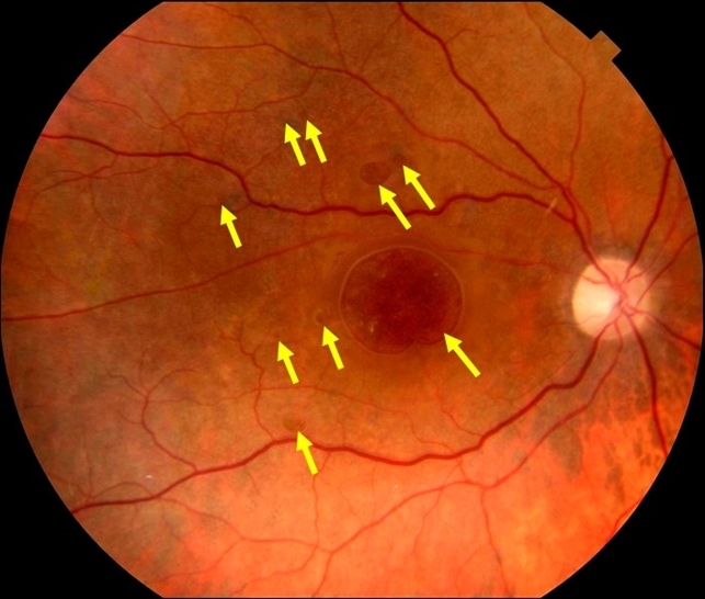 hole of retina