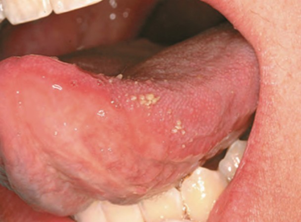 linguopapillitis