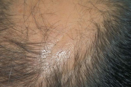 lipedematous alopecia
