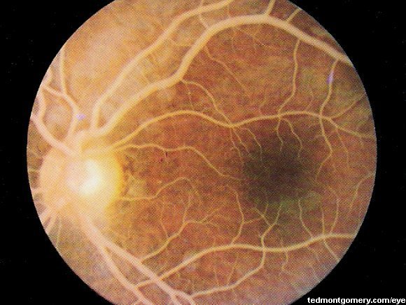 lipemia retinalis