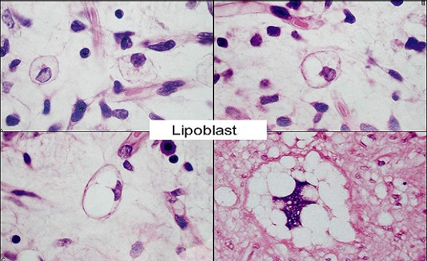 lipoblast