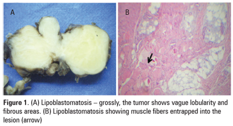 lipoblastomatosis