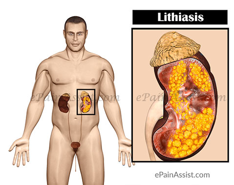 lithiasis