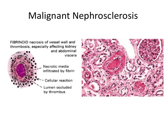 malignant nephrosclerosis