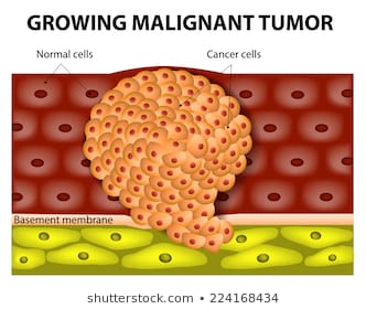 malignant tumor