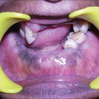 mandibular disease