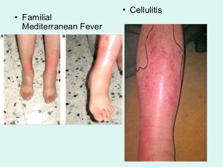 mediterranean exanthematous fever