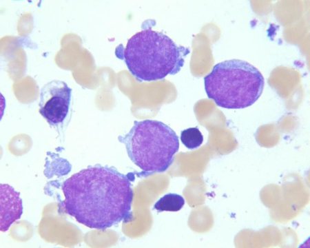 megakaryocytic leukemia