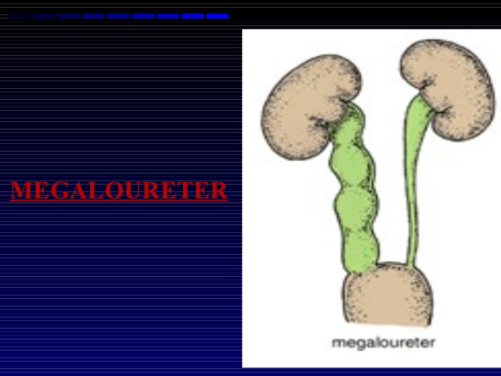 megaloureter