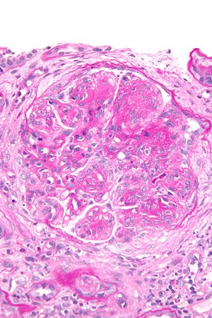 membranoproliferative glomerulonephritis