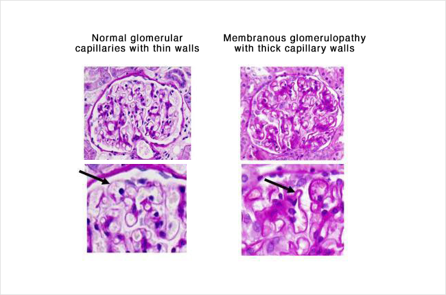 membranous glomerulonephritis