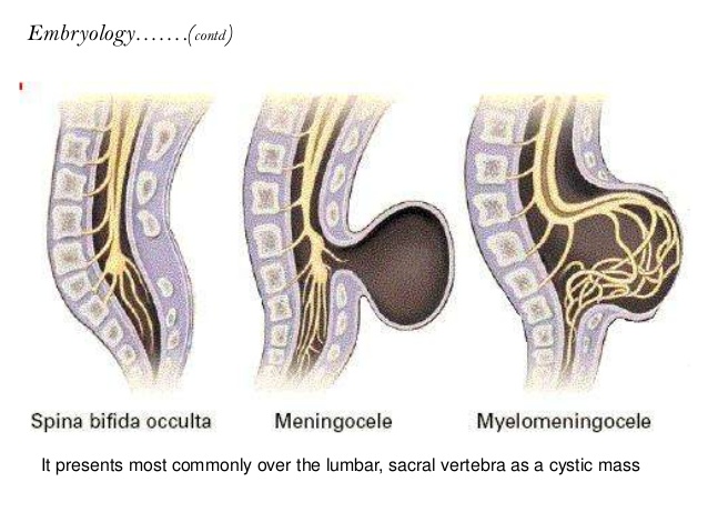 meningomyelocele