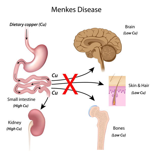 menkes syndrome