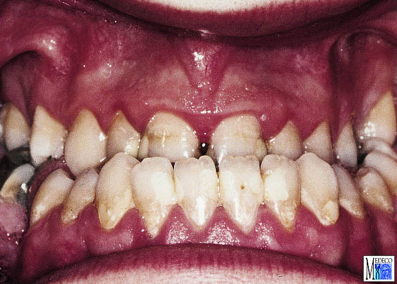 mesial occlusion