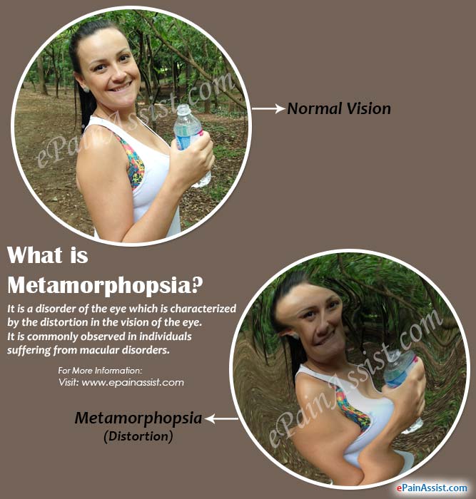 metamorphopsia