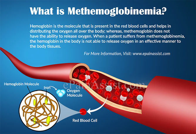 methemoglobinemia
