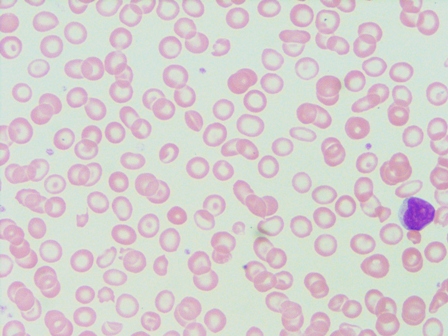 microcyte