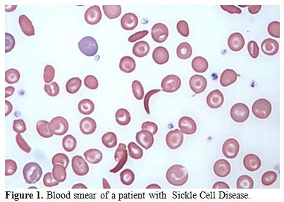 microdrepanocytic anemia