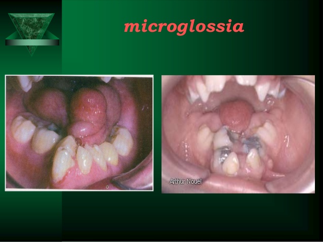 microglossia