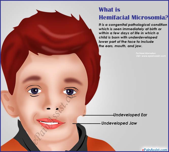 microsomia