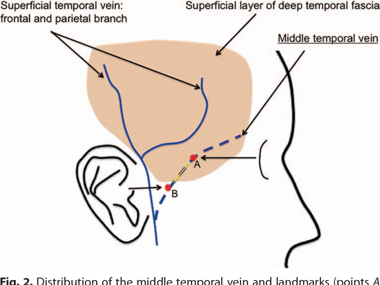 middle temporal vein