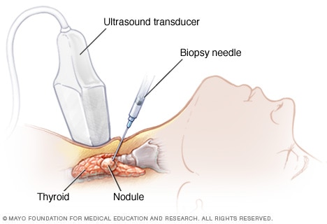 needle biopsy