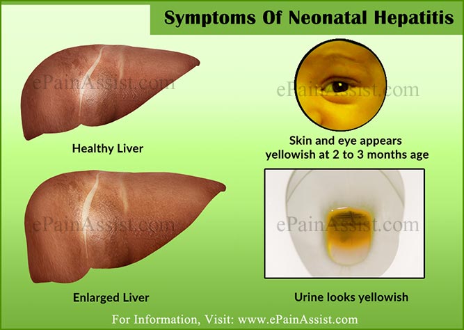 neonatal hepatitis