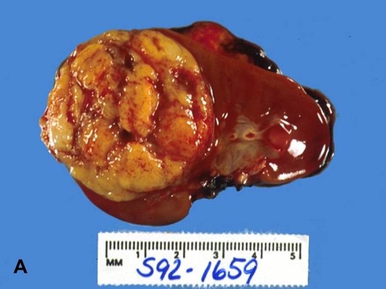 nephroblastoma