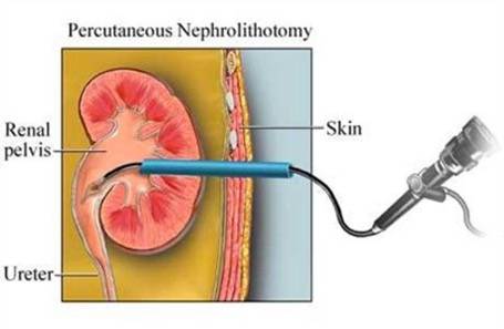 nephrolithotomy