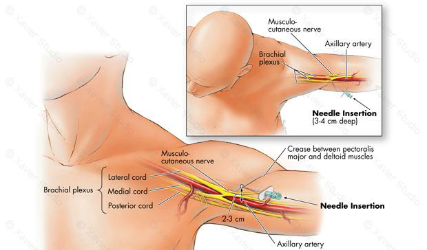 nerve block anesthesia