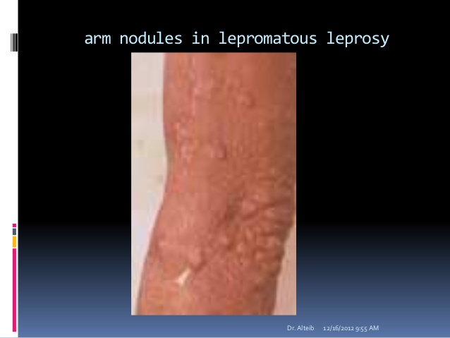 nodular leprosy