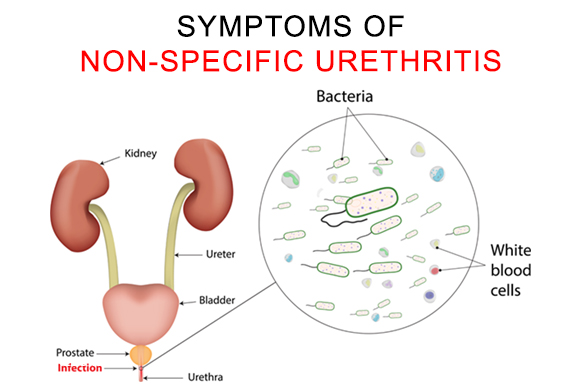 nonspecific urethritis