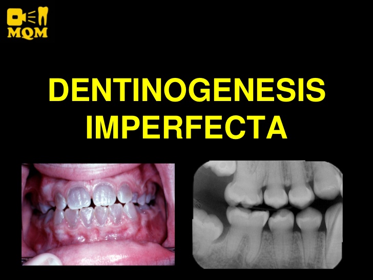 odontogenesis imperfecta