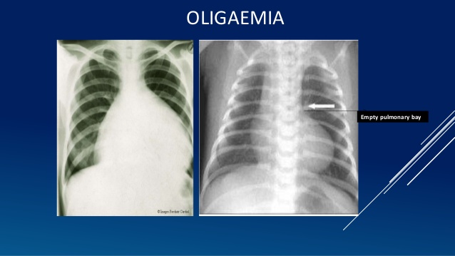 oligaemia