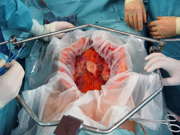 omphalectomy