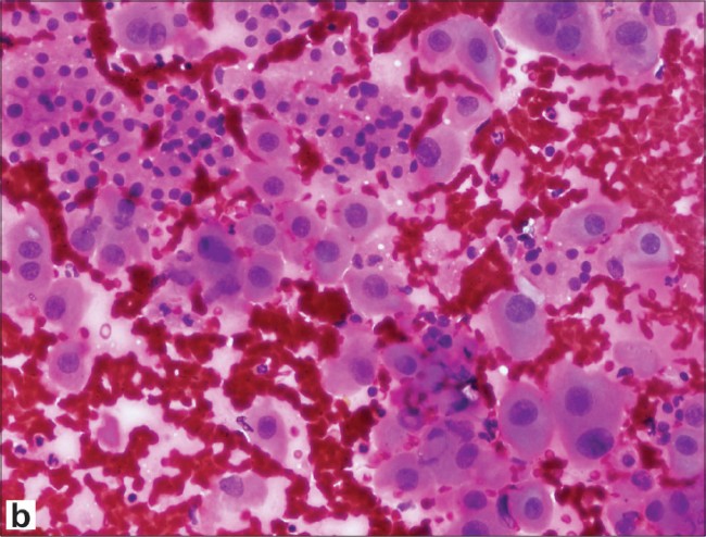 oncocytic hepatocellular tumor
