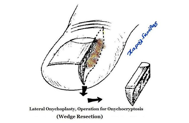 onychoplasty