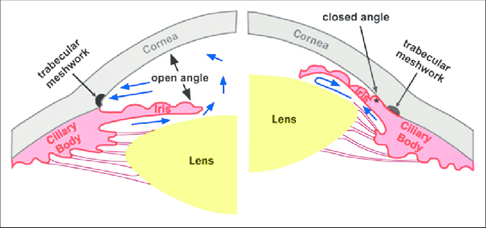 open-angle glaucoma