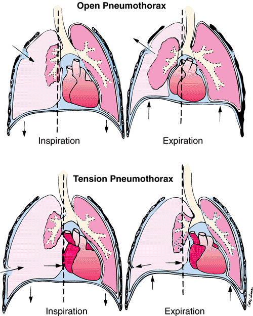 open pneumothorax