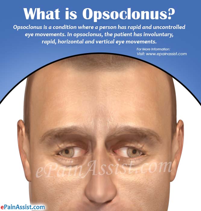 opsoclonus