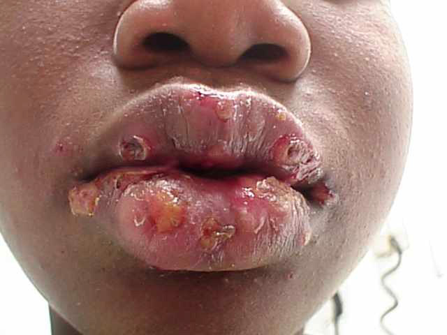 oral herpes