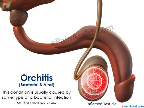 orchitis