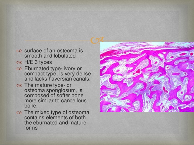 osteoma spongiosum