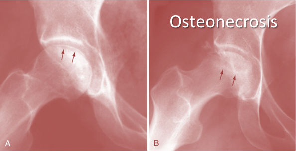 osteonecrosis