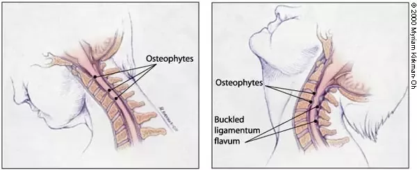 osteophytic