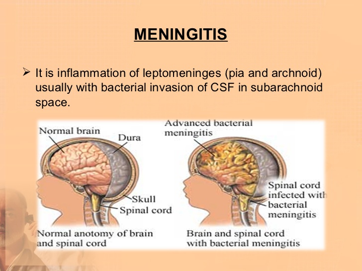 otitic meningitis