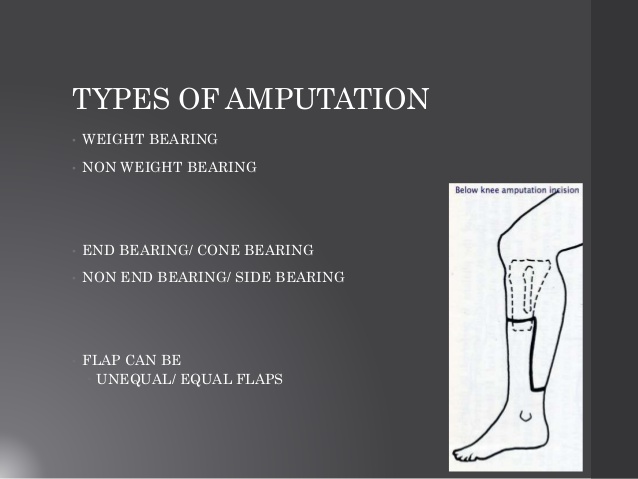 oval amputation